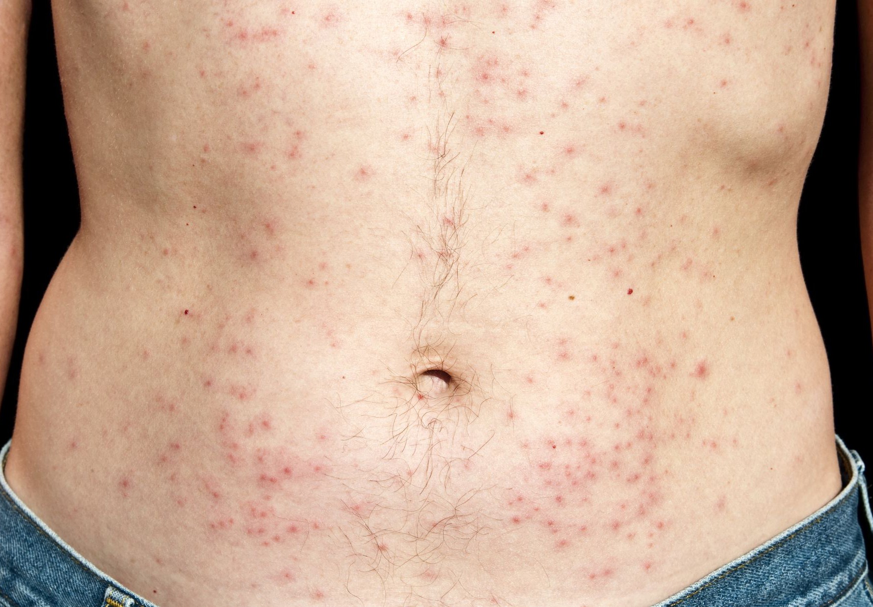 Klor allergi – eller hudbetændelse Psedomonas Man - SpaFix